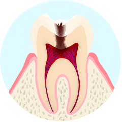 C3：神経まで進んだ虫歯