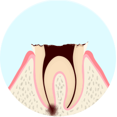 C4：歯全体まで進んだ虫歯